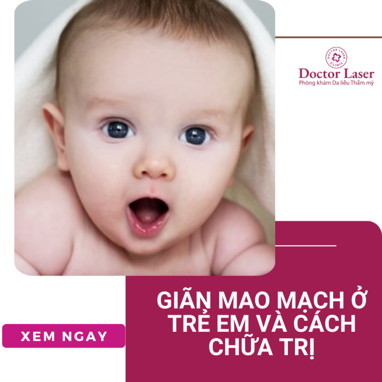 Giãn mao mạch ở trẻ em và cách chữa trị